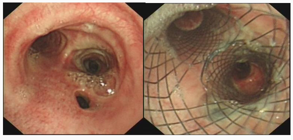 食管覆膜支架图片