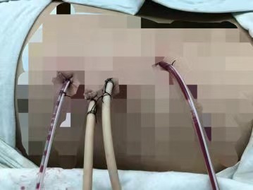 一期多通道经皮肾镜碎石清石术处理鹿角型结石3.jpg