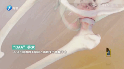 5“DAA”手术模拟动画.GIF