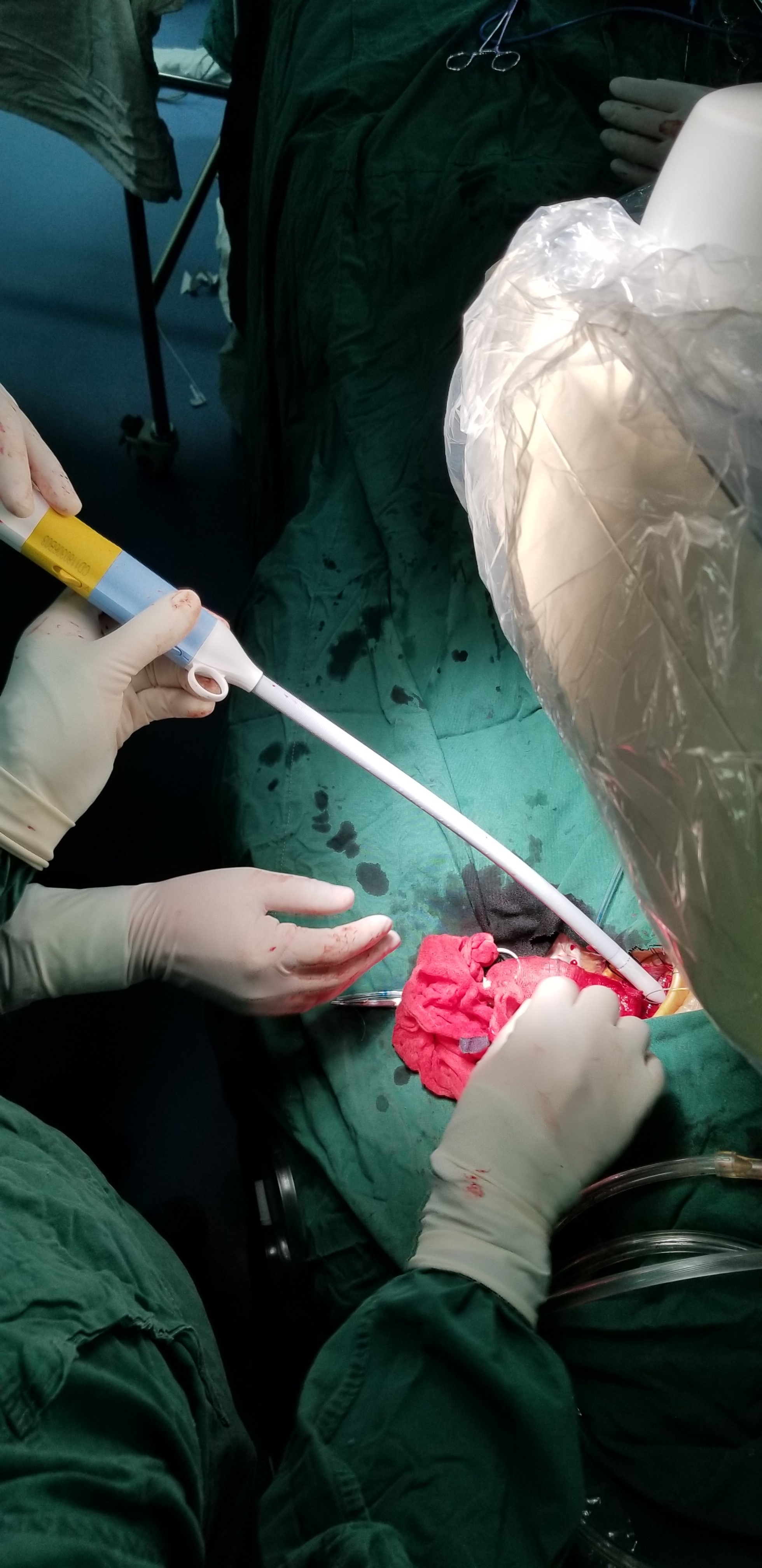 3手术团队为患者施行二尖瓣生物瓣衰败瓣中瓣置换术.jpg