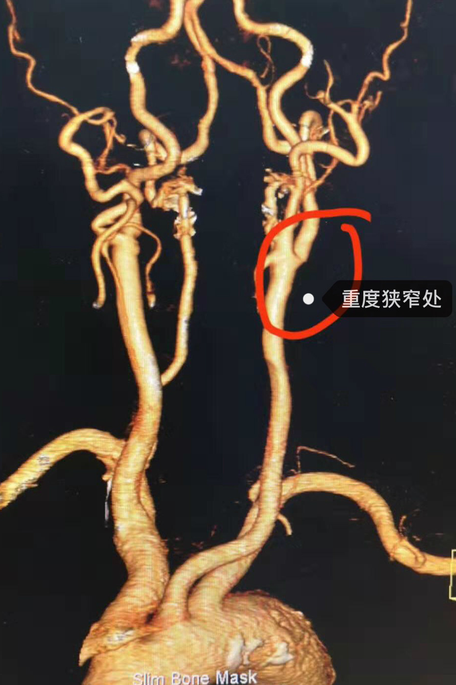 左侧颈动脉重度狭窄1_meitu_3.jpg